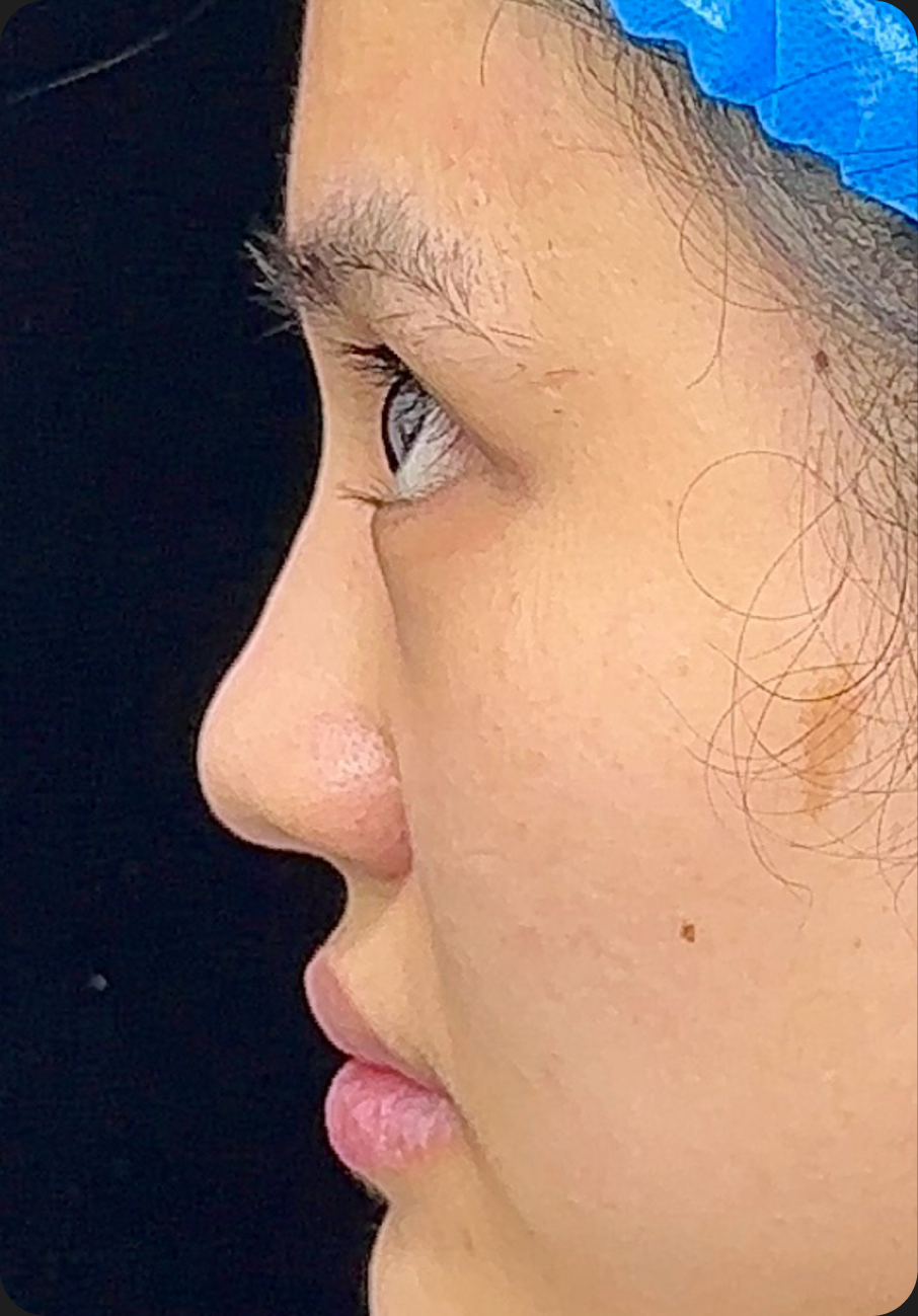 Rhinoplasty after image