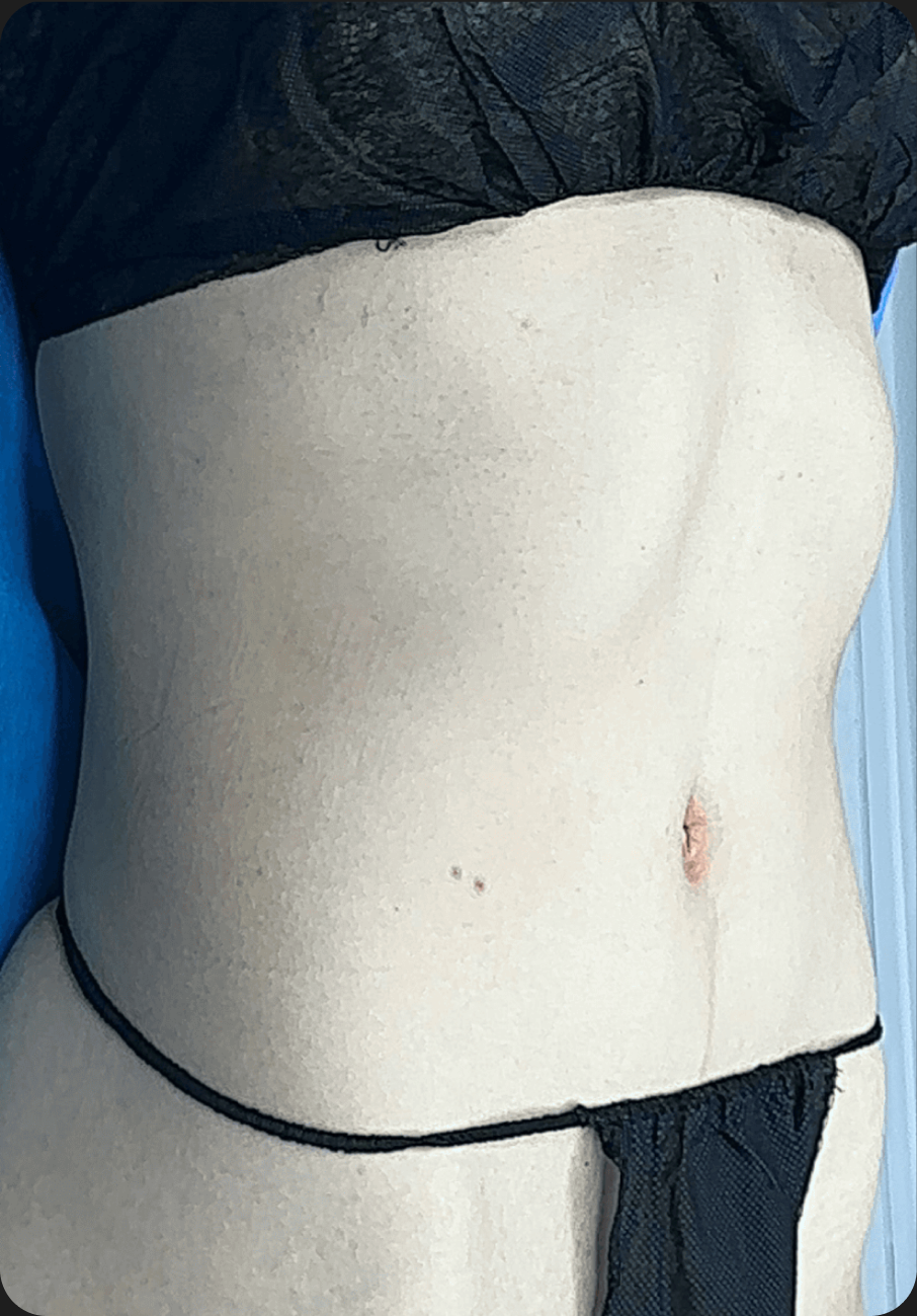 Rib push-in after image