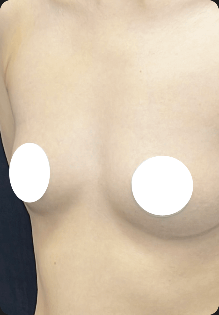Breast augmentation after image