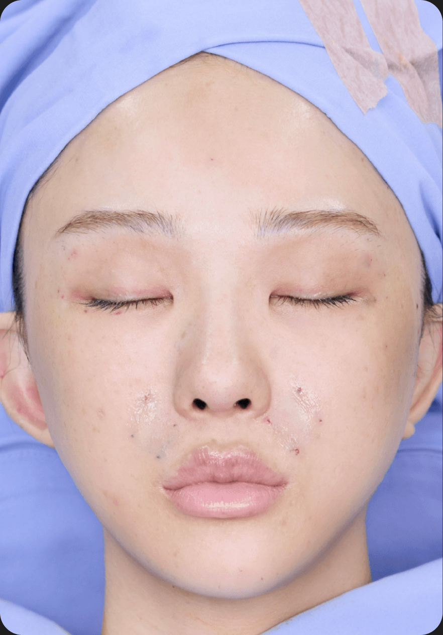Facial lifting before image