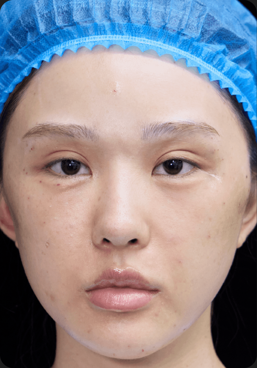 Facial lifting after image