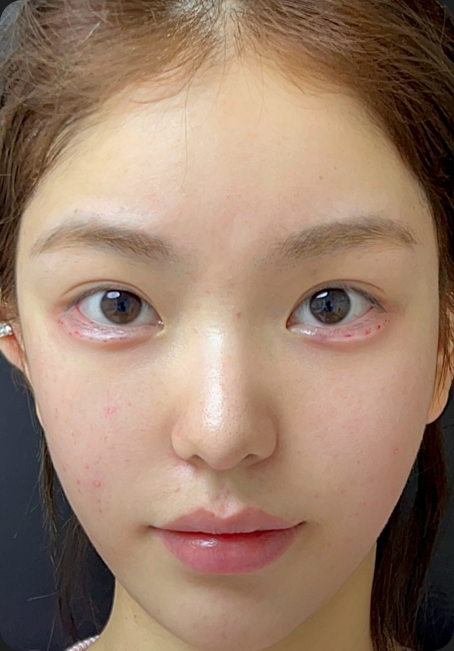 Injectable treatment after image