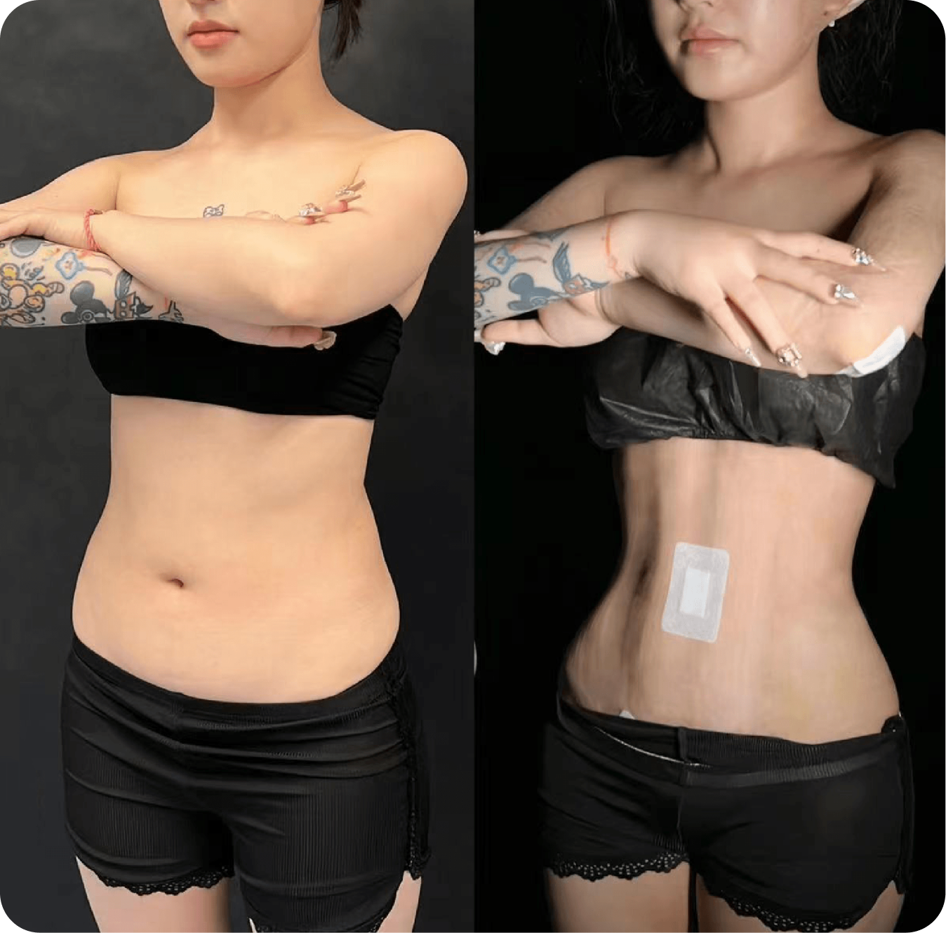 Rib push-in before and after