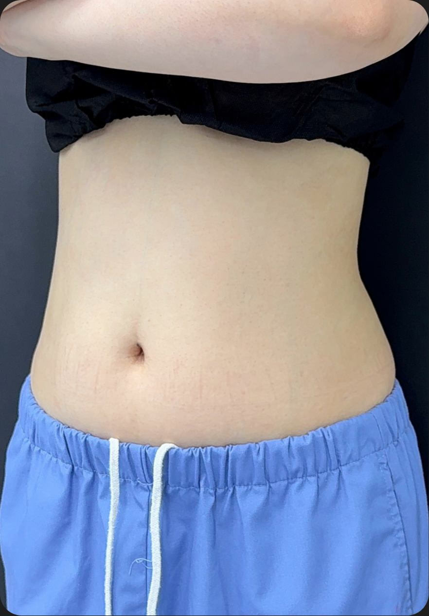 Liposuction before