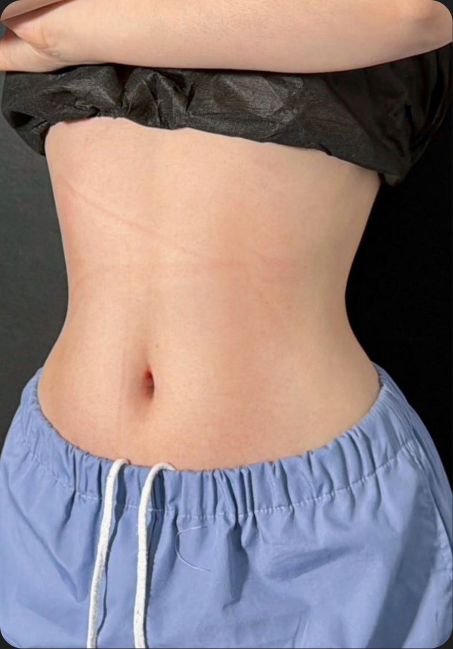 Liposuction after