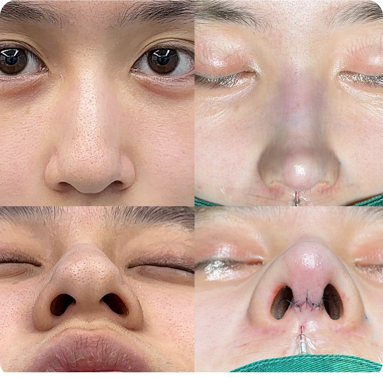 Rhinoplasty clinical details