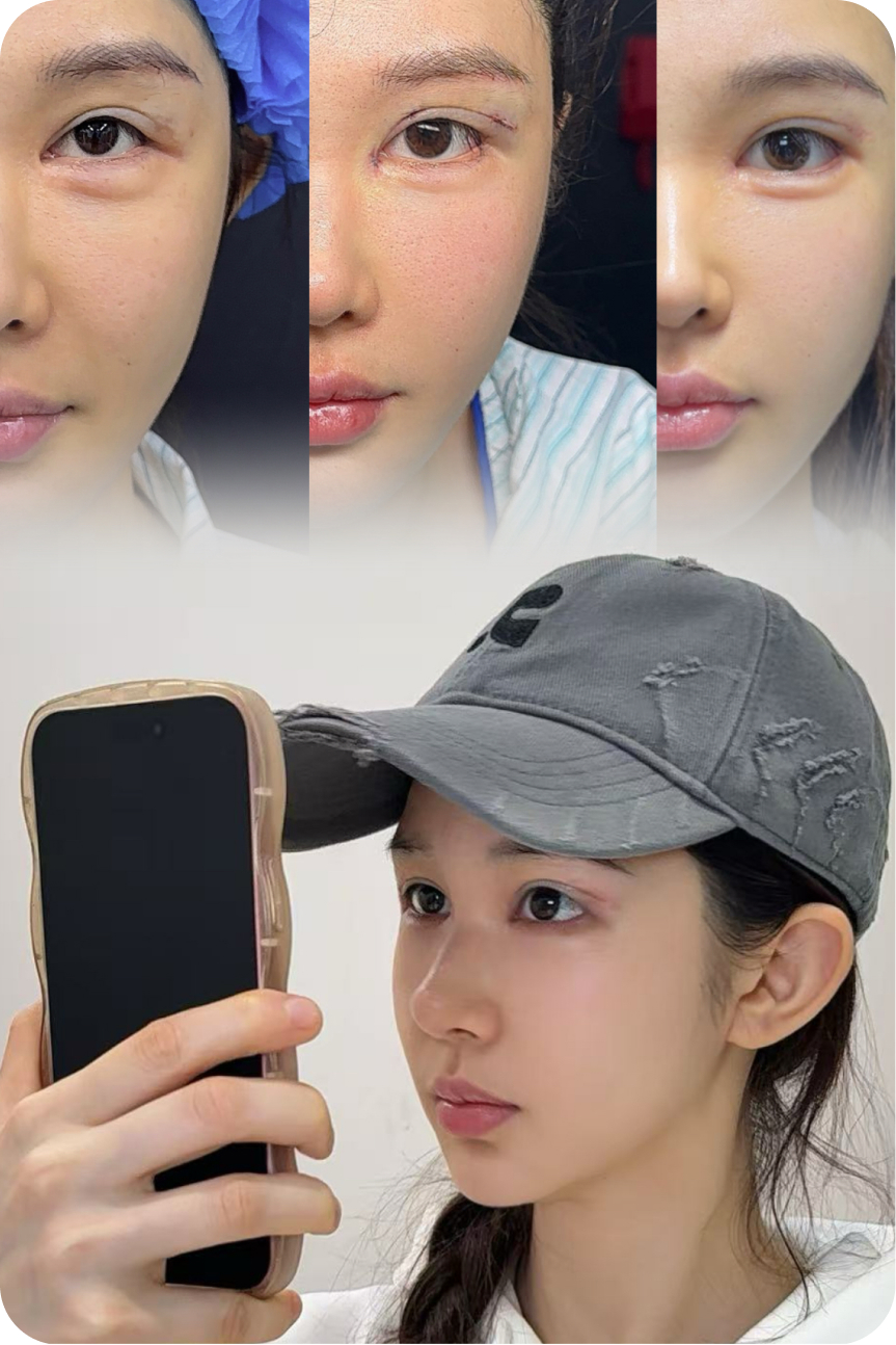 Eye surgery result collage