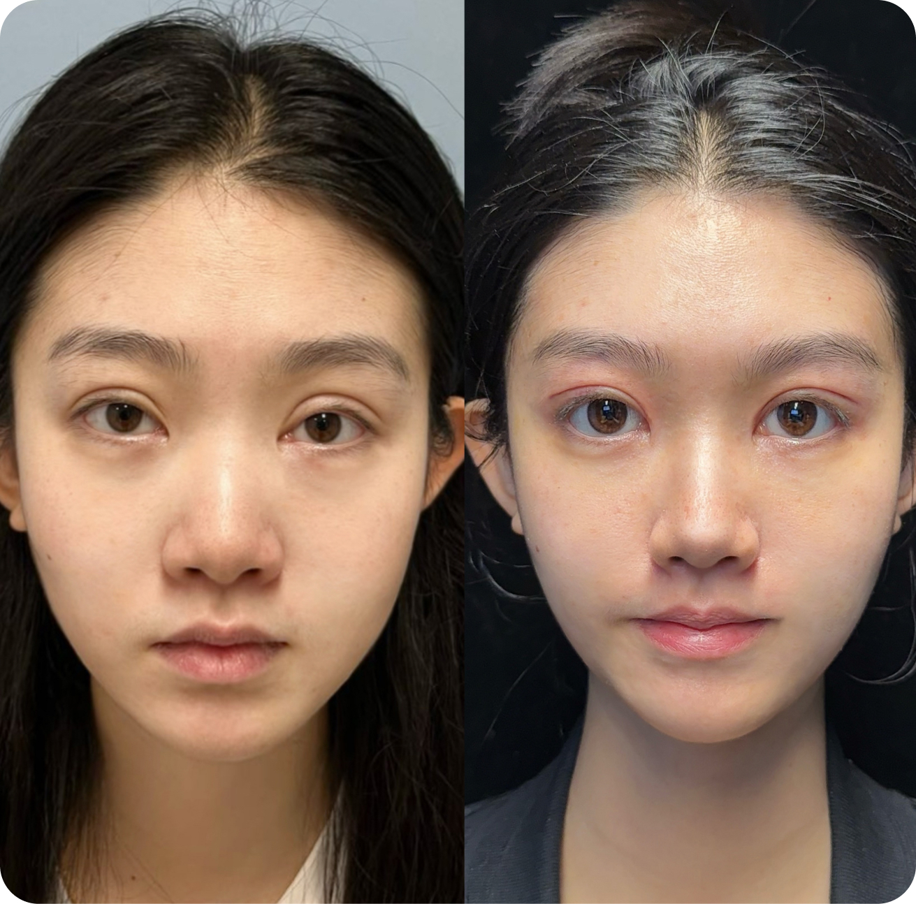 Eye surgery before and after