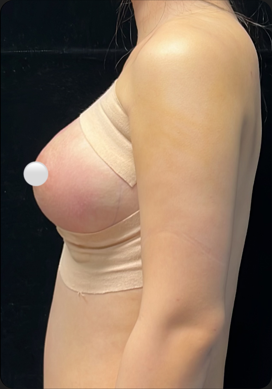 Breast augmentation after