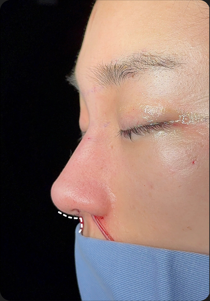 Rhinoplasty before