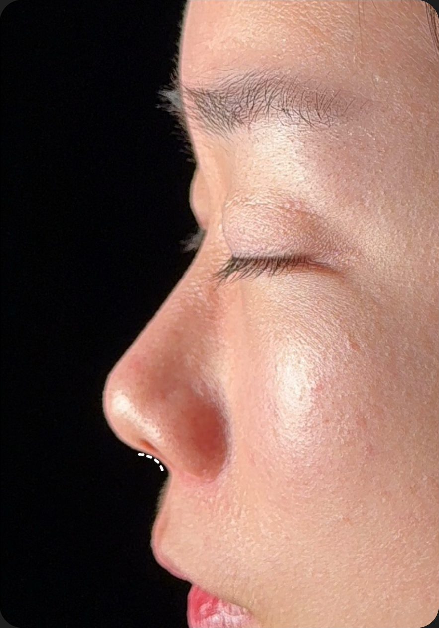 Rhinoplasty after