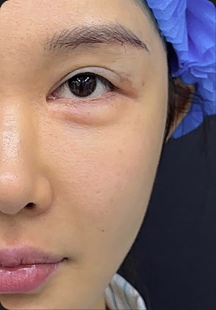 Eye surgery before