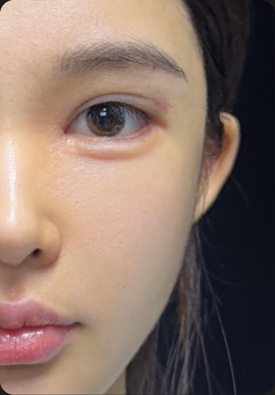 Eye surgery after