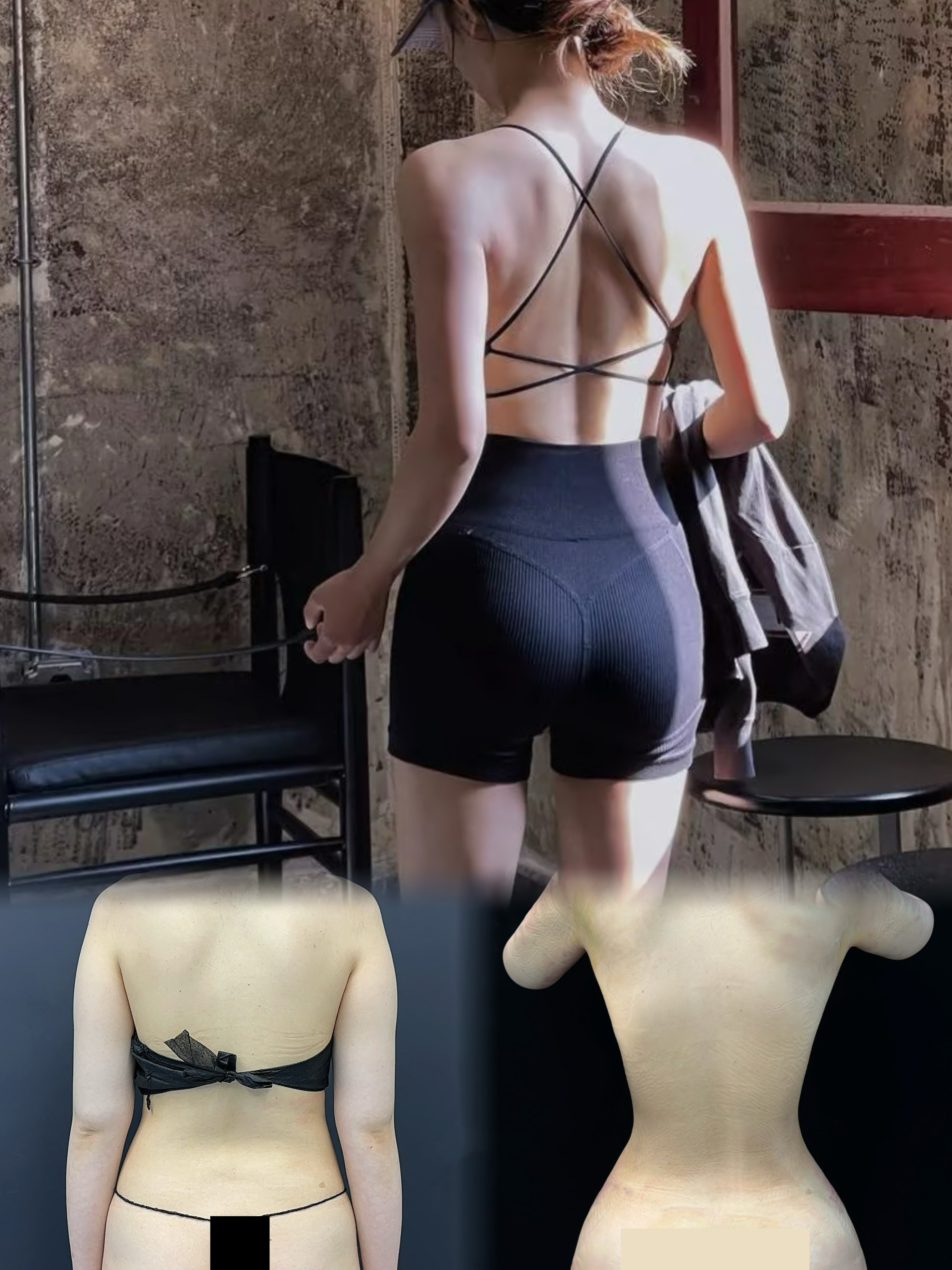 Liposuction and fat grafting result