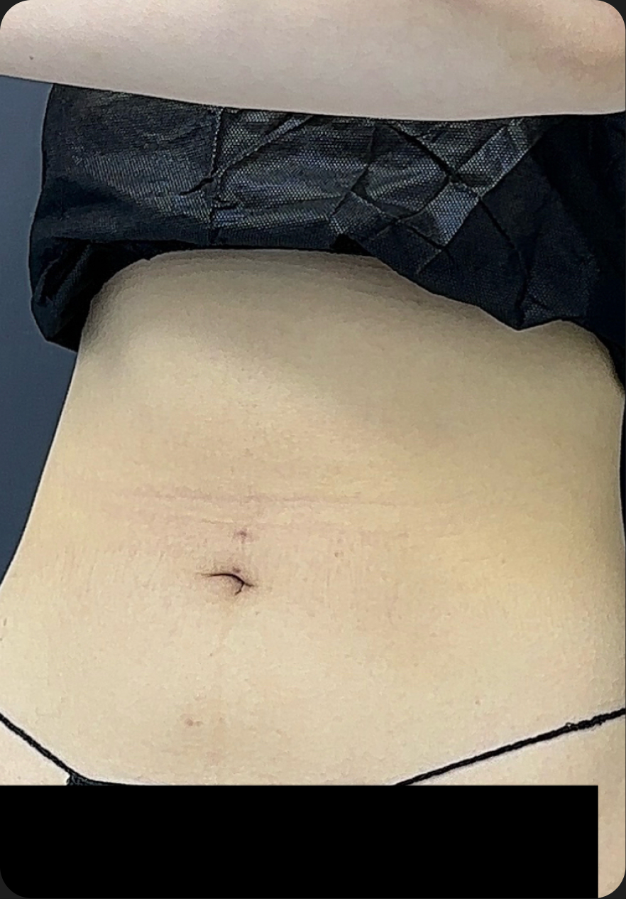 Liposuction before