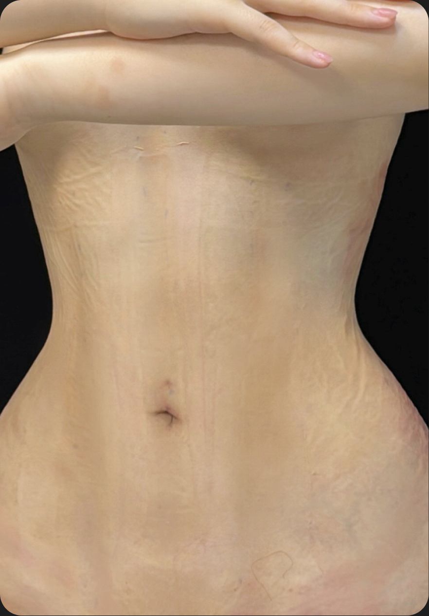 Liposuction after