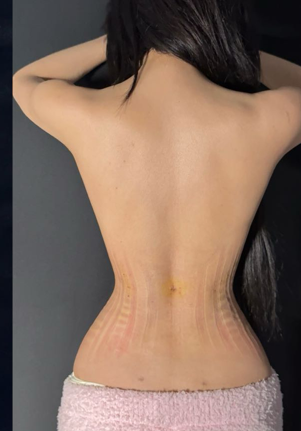 Angled waistline refinement before image
