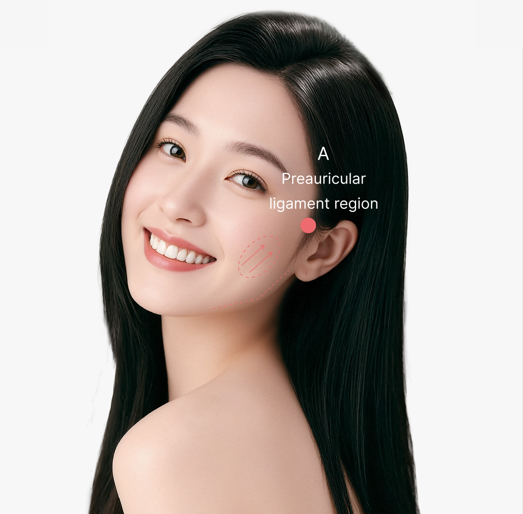 Preauricular Ligament Injection Lifting