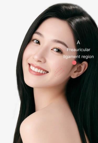 Preauricular Ligament Injection Lifting